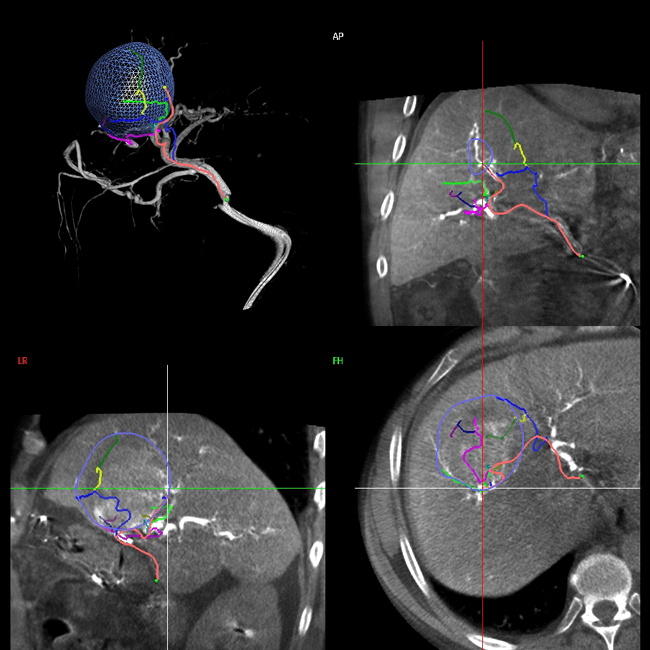 Nueva sala de hemodinamia, Informacin para intervencin vascular